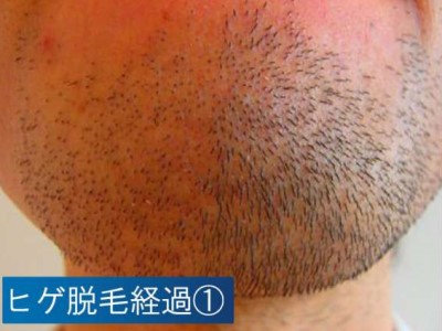 ヒゲ脱毛経過１